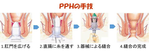PPHの手法