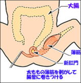 手術による切除