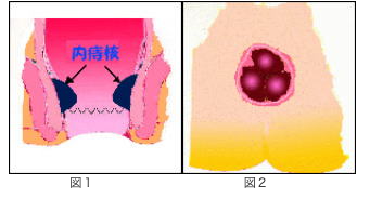 内痔核の症状