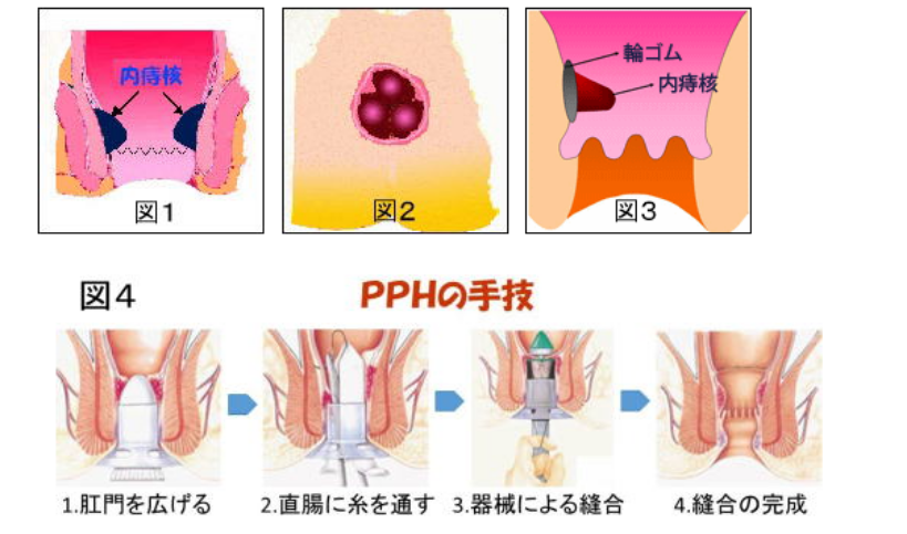 PPHの手技の図