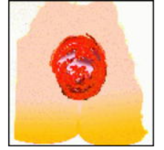 直腸脱の説明図