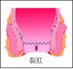 裂肛の説明図