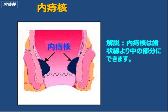 内痔核の説明図