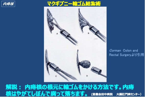 マクギブニー輪ゴム結紮術の説明図