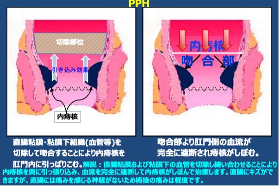 PPHの説明図