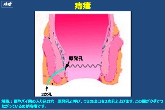 痔瘻の説明図