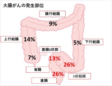 大腸がん発生部位の図