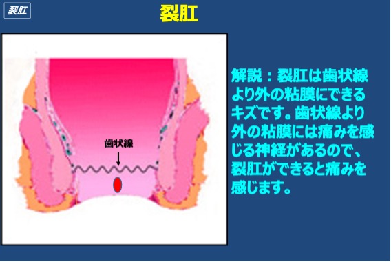 裂肛の説明図