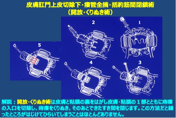 痔瘻の説明図